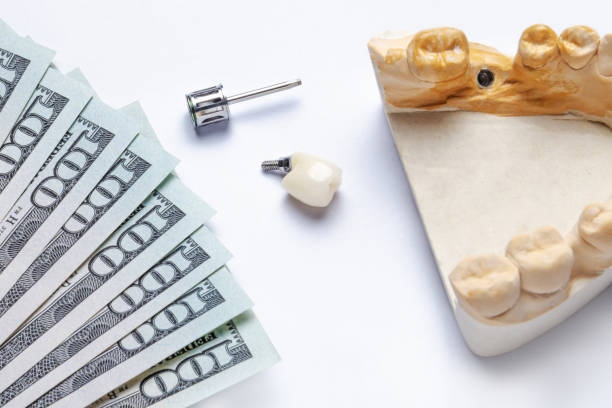 Best dental implants in Turkey cost