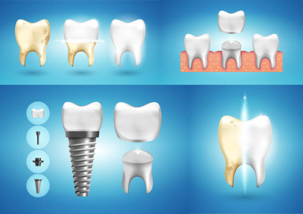 Dental Crowns Turkey – Prices, Types & Full Guide 2026