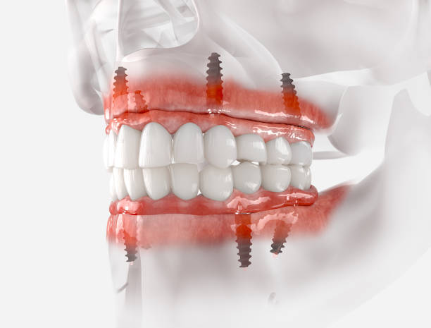 Full mouth dental implants Turkey price