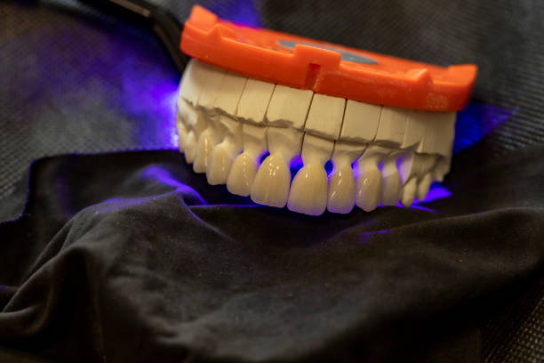 Composite veneers Turkey