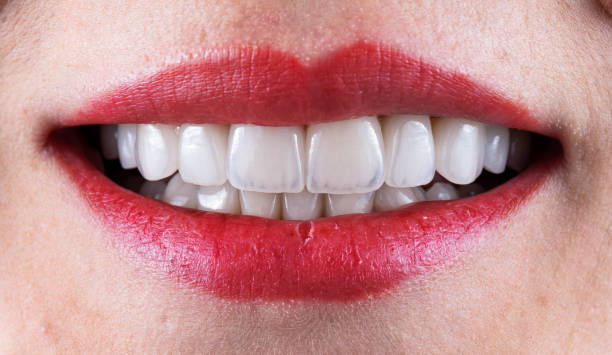 Dental Veneers Turkey – Cost, Types & Before/After Results