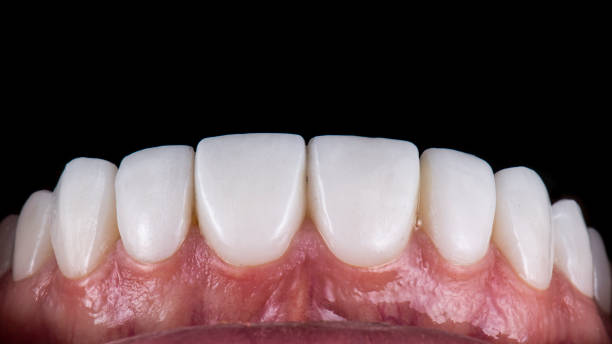 Composite bonding teeth Turkey cost