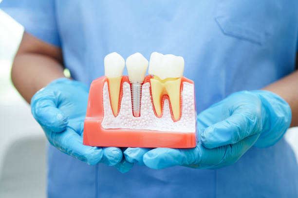 Dental implants Istanbul reviews