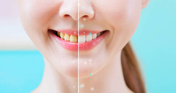 Hollywood smile before after Turkey