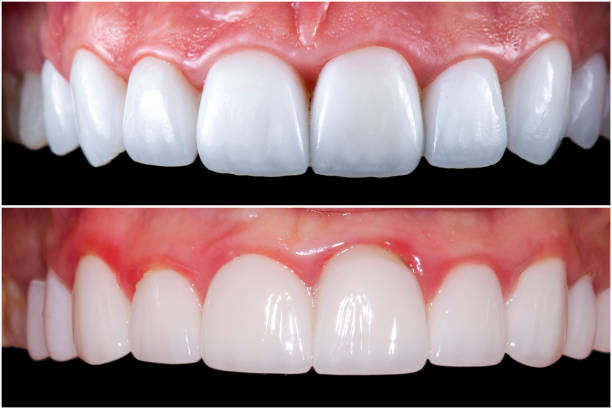 Dental Veneers Turkey – Cost, Types & Before/After Results
