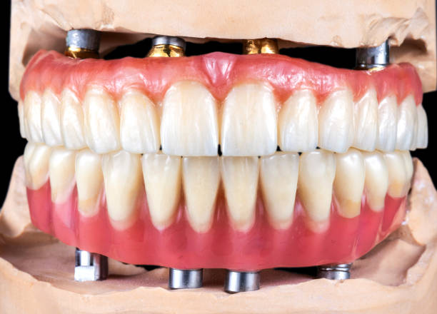 Full mouth dental implants Turkey price reddit