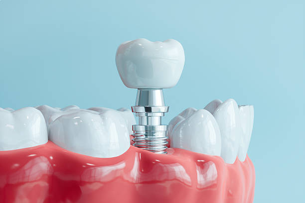 Dental implants Istanbul reviews