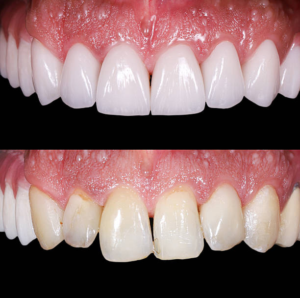 Dental Veneers Turkey – Cost, Types & Before/After ResultsDental Veneers Turkey – Cost, Types & Before/After Results represent the ultimate milestone for individuals seeking to comprehensively understand and achieve a flawless smile rehabilitation. Dental Veneers Turkey – Cost, Types & Before/After Results Navigating the world of advanced cosmetic dentistry requires a clear breakdown of how clinical choices affect your final outcome. The overall dental veneers Turkey cost has become a central focus for international patients, offering an accessible gateway to premium global materials and elite dental artistry without the prohibitive expenses found in Western clinics. When evaluating your treatment plan, the financial aspect is heavily tied to material science, where the porcelain veneers Turkey price reflects the premium nature of ultra-durable, biocompatible glass-ceramics that perfectly mimic natural enamel translucency and resist long-term staining. For patients looking for a minimally invasive, single-visit alternative that preserves maximum natural tooth structure, composite veneers Turkey procedures offer an excellent direct bonding solution using advanced engineered resins sculpted precisely onto the enamel. To appreciate the clinical precision involved, exploring veneers Istanbul before and after portfolios provides objective visual evidence of how structural anomalies, severe discoloration, and occlusal misalignments are harmoniously corrected. Ultimately, securing these life-changing results depends on choosing the right specialist; the best veneers Turkey experience combines advanced digital smile design with strict gnathological protocols to ensure your new smile functions in perfect harmony with your jaw joints and facial anatomy, delivering a truly bespoke transformation. Elevate your long-term oral health and facial symmetry under the expert guidance of Dr. Assi in Istanbul – Turkey, where advanced digital smile design meets elite clinical precision to craft your perfect smile; reach out to our specialized team today via email at info@drassiclinic.com or through direct phone support at +90 544 338 18 00 to secure your comprehensive biocompatible treatment. Dental Veneers Turkey – Cost, Types & Before/After Results Dental Veneers Turkey – Cost, Types & Before/After Results serve as the definitive benchmark for patients analyzing the clinical and financial parameters of comprehensive smile design. Dental Veneers Turkey – Cost, Types & Before/After Results From a prosthetic perspective, dental veneers are not merely cosmetic overlays, but micro-prosthetic restorations engineered to bond directly with human dentin and enamel to correct structural anomalies, micro-fractures, and intrinsic tetracycline staining. When evaluating Dental Veneers Turkey – Cost, Types & Before/After Results, the primary clinical focus centers on balancing structural preservation with biocompatible materials. By utilizing advanced digital scanning and state-of-the-art European ceramics, specialized clinics deliver premium oral rehabilitation at an optimized cost, making high-tier biomimetic dentistry highly accessible to international patients. Clinical Diagnostics and Dental Tissue Evaluation A successful veneer integration relies completely on rigorous pre-operative screening and the physiological health of the patient's oral structures. Before any structural modifications occur, prosthodontists must analyze the patient's bone density and periodontal baseline to ensure the long-term stability of the restorations. To guarantee that the biological environment is fully prepared for a long-lasting veneer placement, clinicians evaluate several mandatory medical conditions: Subgingival Margin Health: The surrounding gingival tissue must be completely free of active inflammation to ensure a seamless margin fit and prevent future biological complications. Enamel Depth Availability: A minimum thickness of healthy surface enamel is required to facilitate a strong, permanent chemical bond with the adhesive luting resin. Bite Force Distribution: The patient's natural occlusion must be analyzed using digital articulators to eliminate premature contacting points that could cause material shear stress. The longevity and aesthetic outcome of your treatment plan depend entirely on matching your specific dental anatomy with the correct material composition. Selecting the ideal substrate ensures optimal light transmission and structural resilience. The table below outlines the core scientific properties and clinical indications of the primary restorative options utilized in modern smile transformations: Material Classification Elasticity Coefficient Translucency Level Biological Preparation Required Ideal Clinical Case Lithium Disilicate (E-Max) High (Natural Glass) Minimal enamel shaving () Discolored or misaligned anterior teeth Zirconia Base Ceramic Medium-Low Moderate tooth reduction High-stress posterior or severely darkened teeth Micro-Hybrid Resin Composite Medium Non-invasive direct sculpting Minor chips, localized enamel hypoplasia Achieve absolute biological harmony and a masterfully calibrated smile with Dr. Assi in Istanbul – Turkey by contacting info@drassiclinic.com or +90 544 338 18 00. Dental veneers Turkey cost Dental veneers Turkey cost is a pivotal factor drawing thousands of international patients to seek advanced cosmetic dentistry abroad; From a clinical perspective, investing in dental veneers is not merely an aesthetic enhancement, but a structural restoration that involves bonding custom-made, ultra-thin shells of ceramic or composite resin to the anterior surface of the teeth. Dental veneers Turkey cost This procedure effectively corrects structural anomalies, severe intrinsic discoloration, and minor malocclusions while preserving as much natural tooth structure as possible. The highly competitive dental veneers Turkey cost allows patients to access premium, medical-grade materials and cutting-edge digital smile design software at a fraction of the price compared to Western clinics, making elite dental rehabilitation highly accessible. Clinical Preparations and Oral Health Alignment Before considering the financial investment, understanding the biomedical requirements of the procedure is essential. Achieving a successful veneer placement depends entirely on the underlying health of your oral cavity, as veneers cannot be structurally supported by compromised teeth or diseased gums. Clinicians must conduct a thorough diagnostic phase—including 3D digital panoramic X-rays—to evaluate enamel thickness and ensure the absence of periodontal disease. To ensure your treatment plan aligns with clinical safety standards, keep the following medical prerequisites in mind: Enamel Integrity: A sufficient layer of natural enamel is mandatory, as the bonding agent relies on an enamel-to-resin interface to secure the veneer. Periodontal Health: Gums must be completely free of gingivitis or active periodontitis to prevent micro-leakage and premature failure at the margins. Occlusal Stability: Patients with severe bruxism (teeth grinding) require evaluation, as excessive forces can fracture the restorative materials, impacting the overall long-term value of your dental veneers Turkey cost. Type of Veneer Average Lifespan Biological Preparation Required Best Suited For Porcelain E-Max 15–20 Years Minimal enamel shaving (0.5 mm}) Severe staining, lasting durability Zirconium Porcelain 15–20 Years Moderate tooth reduction High-stress posterior or misaligned teeth Composite Resin 5–7 Years Non-invasive (Direct sculpting) Minor chips, quick single-visit fixes Experience the perfect synergy of clinical precision and biocompatible aesthetics with Dr. Assi in Istanbul – Turkey, where your smile is masterfully restored; reach out today via info@drassiclinic.com or +90 544 338 18 00. Our article headlines: Dental Veneers Turkey – Cost, Types & Before/After Results dental veneers Turkey cost porcelain veneers Turkey price composite veneers Turkey veneers Istanbul before and after best veneers Turkey Porcelain veneers Turkey price porcelain veneers Turkey price reflects an investment in advanced dental materials that offer unparalleled biocompatibility and natural aesthetics;Clinically, porcelain (specifically lithium disilicate or E-max) is favored by prosthodontists because its optical properties—such as translucency and light opalescence—closely mimic genuine human enamel. Porcelain veneers price Furthermore, the material is highly resistant to marginal discoloration and chemical degradation from dietary acids. While the upfront cost is higher than alternative resins, the long-term value remains highly favorable because porcelain maintains its structural integrity and surface gloss without irritating the surrounding gingival tissues, drastically reducing the risk of secondary caries at the margin boundaries. When analyzing the material science behind the treatment, the physical properties of the ceramic play a critical role in resisting mechanical failures. Modern dental laboratories utilize CAD/CAM (Computer-Aided Design and Manufacturing) technology to mill each veneer from a single, high-density ceramic block, ensuring absolute precision and a flawless fit that eliminates gaps where bacteria could accumulate. To achieve optimal longevity and protect your dental investment within the framework of Dental Veneers Turkey – Cost, Types & Before/After Results, the following physiological factors must be managed during the treatment phase: Marginal Fit: Precision milling ensures that the veneer margin meets the tooth precisely at the gumline, preventing plaque accumulation and chronic gingival inflammation. Bonding Chemistry: The use of specialized resin cements creates a chemical fusion between the etched ceramic and the prepared tooth structure, significantly increasing tensile strength. Functional Longevity: Because high-grade porcelain exhibits a thermal expansion coefficient similar to natural teeth, it tolerates extreme temperature changes without debonding, protecting the underlying tooth structure. This table shows the main features of veneer materials and how they affect appearance, strength, and long-term results: Ceramic Material Clinical Role in Veneers Optical Behavior Mechanical Behavior Biological/Clinical Note Lithium Disilicate (E-max) Good for front teeth veneers Looks very natural and blends well with nearby teeth Strong and reliable for daily use A common choice when both beauty and durability are needed Zirconia-Reinforced Ceramic Used when extra strength is needed Less transparent than E-max, but better for covering dark teeth Very strong and resistant to fracture Helpful in cases that need more masking and durability Feldspathic Porcelain Best for very cosmetic veneers Most natural-looking and highly translucent Not as strong as the other materials Used when the main goal is the best possible appearance CAD/CAM-Milled Veneer Block Used for digitally designed veneers Gives a consistent and predictable color result Provides a precise fit on the tooth Helps reduce gaps and plaque buildup Adhesive Resin–Bonded Veneer System Supports the veneer, even though it is not a ceramic Keeps the natural look of the tooth underneath Helps the veneer stay attached for a long time Strong bonding is important for long-term success Experience premium ceramic engineering and biological smile design with Dr. Assi in Istanbul – Turkey by contacting info@drassiclinic.com or +90 544 338 18 00. Composite veneers Turkey composite veneers Turkey procedures represent a highly efficient, direct restorative technique in modern cosmetic dentistry, offering an excellent balance between structural preservation and aesthetic enhancement. Composite veneers Turkey layer-by-layer application of a photo-polymerizable, submicron hybrid resin directly onto the tooth enamel. Unlike ceramic alternatives, this biomaterial allows the clinician to preserve the maximum amount of natural tooth structure, often requiring zero irreversible enamel reduction. The specialized resin matrix is precisely engineered with micro-fillers that mimic the natural refractive index of teeth, making it an ideal choice for instantly correcting minor diastemas, incisal fractures, and localized enamel hypoplasia in a single clinical appointment. Polymerization Chemistry and Micro-Aesthetic Adjustments The success and longevity of direct resin restorations depend heavily on the clinician's command over material science and polymerization kinetics. Using a specialized curing light, the dentist initiates a chemical reaction that transforms the pliable paste into a rigid, highly polished matrix that integrates seamlessly with the surrounding dental tissues. To ensure the biological safety and long-term stability of the composite resin within the comprehensive framework of Dental Veneers Turkey – Cost, Types & Before/After Results, several clinical parameters must be strictly managed: Incremental Layering: Applying the composite in layers thinner than prevents polymerization shrinkage, which could otherwise create microscopic gaps and lead to post-operative sensitivity. Moisture Control: Complete isolation of the oral treatment field using a rubber dam is vital, as any moisture or salivary contamination will completely compromise the adhesive bond. Super-Polishing Protocols: Utilizing multi-step aluminum oxide discs and diamond pastes eliminates surface roughness, preventing plaque retention and maintaining gingival health. The mechanical performance of modern dental composites is determined by their internal structural composition. Selecting the correct filler size ensures that the restoration can withstand regular masticatory forces while retaining its surface smoothness over time. The table below outlines the distinct clinical properties of modern composite resin variants used to achieve precise aesthetic and functional results: Composite Filler Category Average Filler Size Polish Retention Compressive Strength Primary Clinical Indication Nanofilled Resins () Excellent (High Gloss) Moderate Anterior teeth requiring high aesthetics Microhybrid Resins Good High Stress-bearing posterior restorations Nanocomposites Cluster Form Excellent High Versatile use for both anterior and posterior This is our Patient's experience shared with us: "I was deeply concerned about structural enamel loss, so I spent months researching options online while evaluating clinical outcomes and treatment options. After reading extensively about Dental Veneers Turkey – Cost, Types & Before/After Results, I decided to choose Dr. Assi because his approach focused entirely on preserving my natural teeth using high-grade composite materials. The transition was smooth, transparent, and completely pain-free; he meticulously sculpted each tooth to match my natural facial symmetry, proving to me that he is truly one of the best specialists in Istanbul." Protect your natural enamel with non-invasive, custom-sculpted direct resin restorations engineered by Dr. Assi in Istanbul – Turkey; contact our clinical team today at info@drassiclinic.com or +90 544 338 18 00. veneers Istanbul before and after veneers Istanbul before and after documentation serves as a critical diagnostic and evaluative tool in advanced cosmetic dentistry, providing objective proof of successful neuromuscular and cosmetic rehabilitation. Clinically, these photographic and digital case studies capture the precise alignment of the dental midline with the patient's facial axis, as well as the restoration of the correct incisal edge position. By analyzing veneers Istanbul before and after records, prosthodontists can evaluate how the new restorations support the lip profile and balance the buccal corridor (the dark space visible at the corners of the mouth when smiling). This systematic approach ensures that patients studying Dental Veneers Turkey – Cost, Types & Before/After Results receive a customized treatment plan that fundamentally enhances both structural symmetry and long-term oral functionality. Photogrammetric Analysis and Digital Smile Design Protocols The transition from the initial presentation to the final outcome requires precise multi-angle clinical photography and 3D intraoral scanning. These diagnostic records allow the dental team to calculate the exact golden proportions of the anterior teeth, ensuring the width-to-length ratio aligns harmoniously with the patient's unique facial anatomy. To guarantee an optimal aesthetic and functional transition during the smile design process, clinicians systematically evaluate several specialized morphological milestones: Zenith Symmetry: The highest point of the gingival contour (the gumline architecture) of each tooth must be precisely aligned to create a balanced, youthful frame for the new restorations. Incisal Embrasures: The small, V-shaped spaces between the biting edges of the teeth are carefully calibrated to prevent an artificial, monochromatic "block-like" appearance. Phonetic Validation: Temporary diagnostic mock-ups are clinically tested while the patient speaks to ensure the new tooth lengths do not interfere with natural speech patterns or alveolar airflow. A true smile transformation extends far beyond surface aesthetics, requiring the careful calibration of mandibular movements to prevent premature material wear. Ensuring proper functional harmony prevents the development of localized stress concentrations that could compromise the underlying dental work under the framework of Dental Veneers Turkey – Cost, Types & Before/After Results. The table below outlines the specific clinical parameters monitored during the diagnostic phase to ensure long-term mechanical stability: Clinical Diagnostic Metric Ideal Physiological Range Impact on Veneer Longevity Biomechanical Purpose Interincisal Angle Prevents palatal collision forces Establishes correct anterior guidance Gingival Display Less than during full smile Eliminates "gummy smile" appearance Harmonizes the soft tissue framework Overbite Depth vertical overlap Avoids excessive shear stress on margins Protects the ceramic-to-enamel interface Achieve a perfectly calibrated, long-lasting smile transformation overseen by Dr. Assi in Istanbul – Turkey; reach out to our clinic at info@drassiclinic.com or +90 544 338 18 00. Best veneers Turkey best veneers Turkey clinics distinguish themselves by strictly adhering to advanced gnathological principles and individualized biomimetic dentistry; Rather than merely addressing the surface aesthetics of the anterior teeth, top-tier clinical operations analyze the patient's complete temporomandibular joint (TMJ) function and masticatory muscle pathways before custom-fabricating any restorations. Best veneers Turkey This comprehensive neuromuscular approach ensures that the veneers do not disrupt the patient's established centric occlusion or cause long-term myofascial pain. By prioritizing individual muscle harmony alongside premium material selection, these specialized centers guarantee that patients analyzing Dental Veneers Turkey – Cost, Types & Before/After Results receive restorations that function seamlessly as a natural extension of their biological masticatory system. Neuromuscular Alignment and Biomimetic Integration Achieving elite dental results requires a profound understanding of how ceramic structures interact with vital peripheral tissues. Top clinical specialists utilize microscopic magnification during the tooth preparation phase to preserve the maximum amount of sound dentin, ensuring the subgingival margins remain completely biocompatible. To maintain perfect integration within the oral cavity, the following specialized clinical protocols must be meticulously executed: Periodontal Biotype Calibration: The contouring of the cervical third of the veneer must be precisely adapted to the patient's specific thin or thick gum tissue profile to prevent future recession. Proprioceptive Harmony: The highly specialized palatal contours of the restorations are carefully sculpted to preserve natural tongue contact and maintain ideal neurological feedback during chewing. Micro-Leakage Eradication: Utilizing rubber dam isolation alongside advanced dual-cure adhesive resins completely eliminates the risk of microscopic structural fluid contamination beneath the veneer. The long-term success of premium restorations depends heavily on selecting materials whose physical properties match the natural elasticity of human dentin. Balancing these forces prevents internal stress distribution errors that could lead to unexpected ceramic fractures over time within the scope of your Dental Veneers Turkey – Cost, Types & Before/After Results treatment plan. The table below breaks down the specific biomechanical properties and clinical indicators utilized by the highest-rated dental specialists to ensure structural longevity: Advanced Structural Material Modulus of Elasticity Fracture Toughness Structural Indication Clinical Benefit Leucite-Reinforced Glass ≈65 GPa 1.2 MPa⋅m (1/2) Isolated anterior restorations Excellent natural wear characteristics Fluorapatite Glass-Ceramic ≈70 GPa 1.3 MPa⋅m (1/2) Complex smile re-contouring Mimics internal tooth structure light scattering Monolithic High-Translucency ≈210 GPa 4.5 MPa⋅m (1/2) High stress heavy bite cases Maximum resistance against structural shear forces Elevate your long-term oral health and facial symmetry under the expert guidance of Dr. Assi in Istanbul – Turkey by connecting with us at info@drassiclinic.com or +90 544 338 18 00. We mentioned in our article: Dental Veneers Turkey – Cost, Types & Before/After Results dental veneers Turkey cost porcelain veneers Turkey price composite veneers Turkey veneers Istanbul before and after best veneers Turkey FAQ How long is the recovery for Dental Veneers Turkey – Cost, Types & Before/After Results? Recovery is immediate with no downtime; Dr. Assi utilizes minimally invasive techniques to ensure you enjoy your new smile the very same day. How long does it take to get a full set of veneers in Turkey? The process typically spans 5 to 7 days, as Dr. Assi employs advanced in-house digital labs to accelerate your total smile transformation. What happens after 20 years of having veneers? Veneers may eventually need minor refreshing, yet Dr. Assi uses elite medical-grade ceramics to ensure maximum longevity and structural brilliance for decades. Can I go back to normal teeth after veneers? Veneers are a permanent aesthetic commitment; therefore, Dr. Assi focuses on ultra-thin preparations to preserve your natural enamel as much as possible. Is it better to get veneers in the UK or Turkey? Turkey provides world-class results at a fraction of UK prices, with Dr. Assi offering the perfect blend of international quality and exceptional value. veneers Istanbul before and after