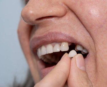 Dental Crowns Turkey – Prices, Types & Full Guide 2026