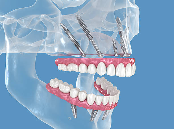 Full mouth dental implants Turkey price