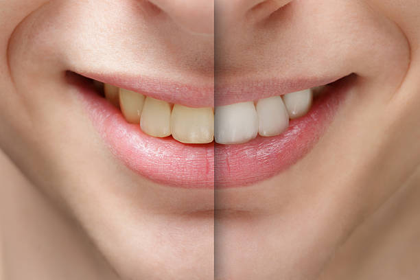 Full smile makeover Turkey