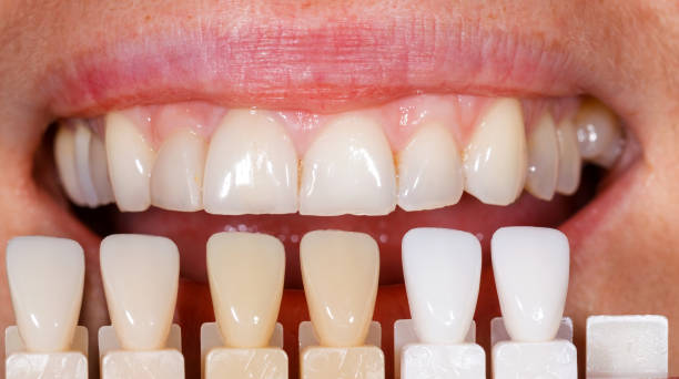 Porcelain veneers price