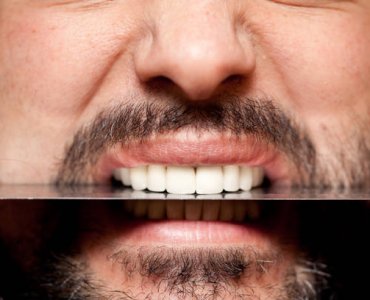 Dental Veneers Turkey – Cost, Types & Before/After Results