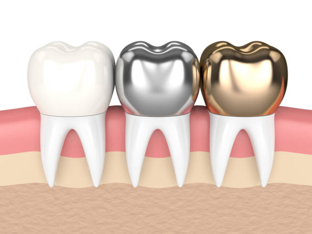 Dental Crowns Turkey – Prices, Types & Full Guide 2026